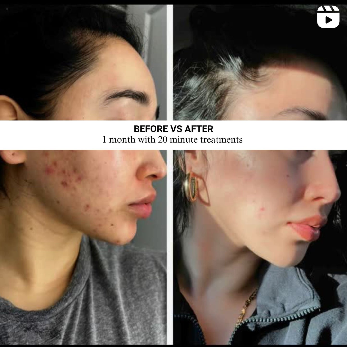 VISO Red Light Face System