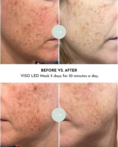 VISO Red Light Face System